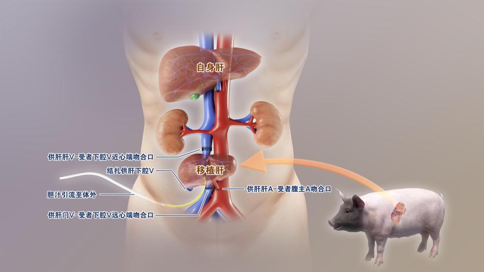 中国团队实现全球首例基因编辑猪肝脏移植人体
